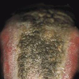 Zwarte haartong (lingua villosa nigra) - Medicinfo