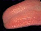 Mild Geographic Tongue or Glossitis
