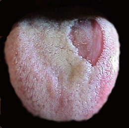 yeast on tongue