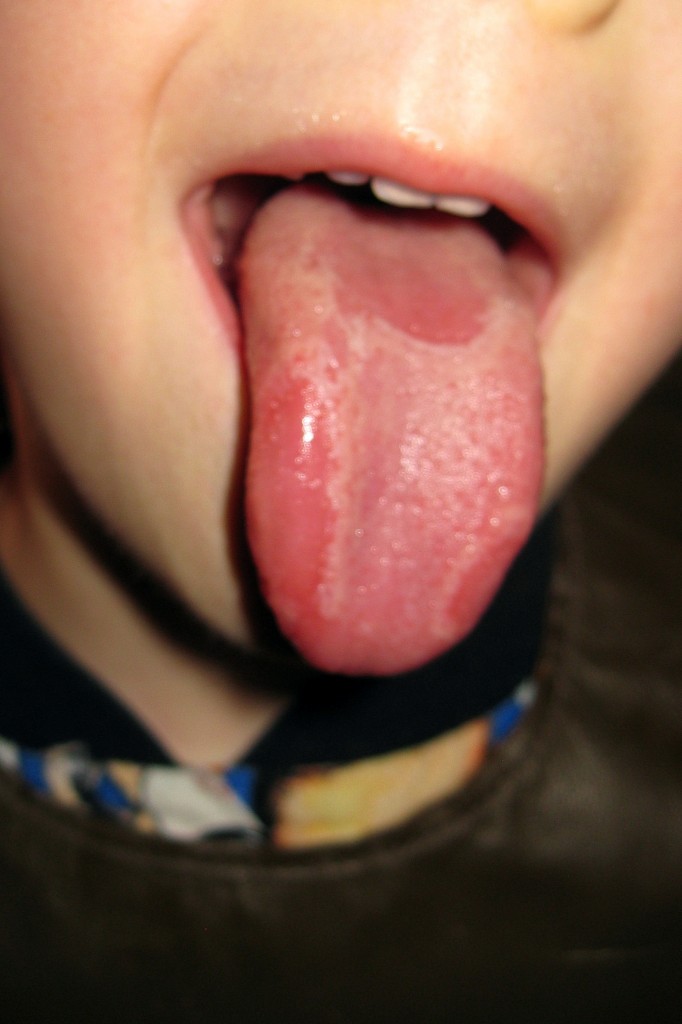 Geographic Tongue_in Boy