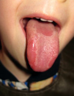 Geographic Tongue in a small boy