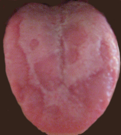 Geographic tongue