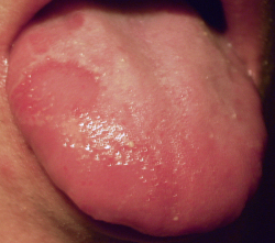 Geographic Tongue Bald Paatch