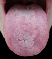 Beefy Enlarged Tongue