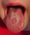 Geographic_Tongue_Toddler