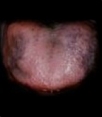Pigmented Tongue